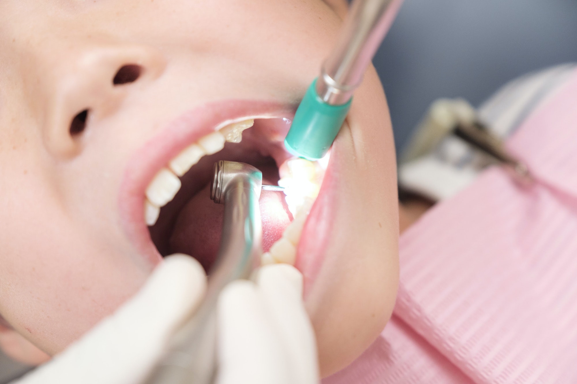 Icon Resin Infiltration