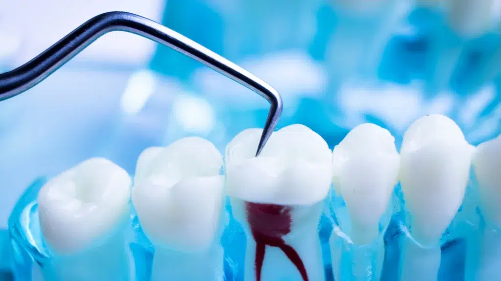 Root Canal Before and After | Little Smiles of Beverly Hills