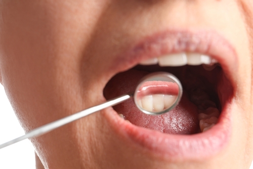 Adult dental cleaning and exam in Beverly Hills by Dr. Sepehr Nassiripour, DDS