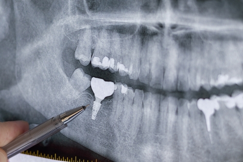 Digital dental X-rays and diagnostics in Beverly Hills by Dr. Sepehr Nassiripour, DDS