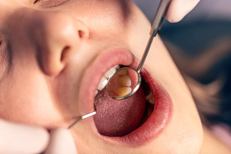 Oral cyst and tumor removal in Beverly Hills by Dr. Sepehr Nassiripour, DDS