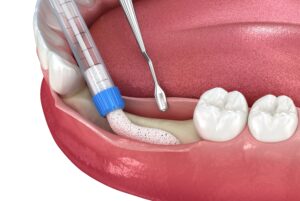Bone graft for dental implant in Beverly Hills